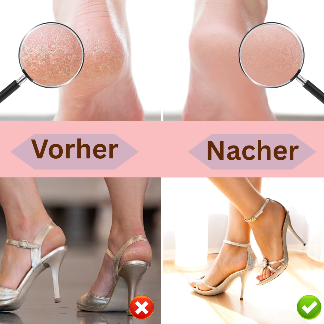 Wiederaufladbarer Hornhautentferner für die Füße